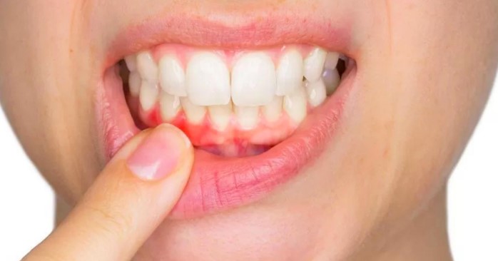 Penyebab, Tipe, dan Pencegahan Abses Gigi